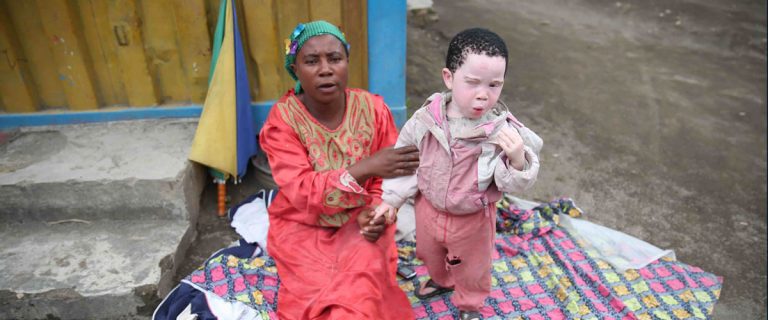 13 June- Maalinta caalamiga ee xannuunka Albinism-ka